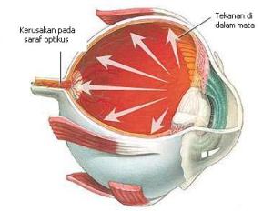obat herbal glaukoma